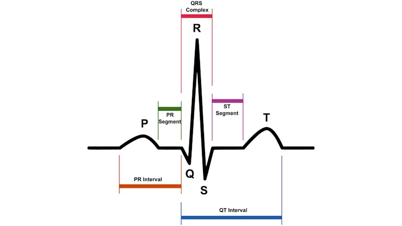 A diagram of an EKG Wave. From left to right there is a P-wave, Q-wave, R-wave, S-wave, and T-wave, which combined can make up intervals, segments, or complexes.